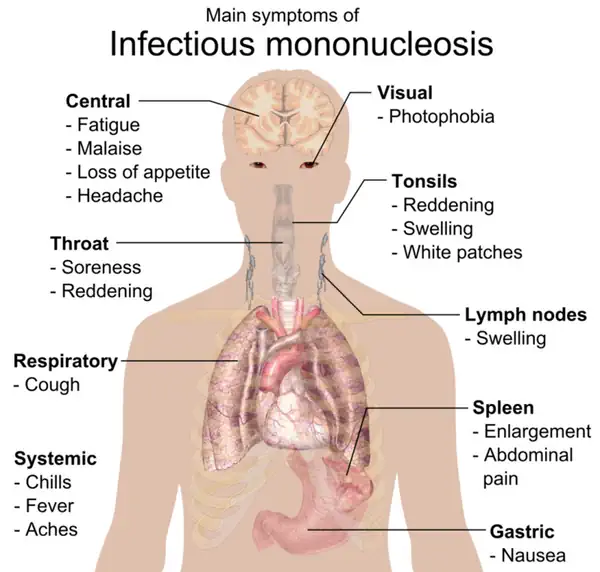 2023Main symptoms Infectious mononucleosis