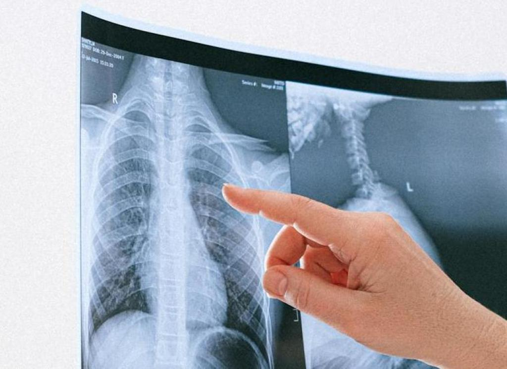 radiografia polmoni